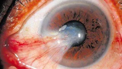 眼睛里長了小翅膀怎么辦？警惕視力殺手翼狀胬肉！